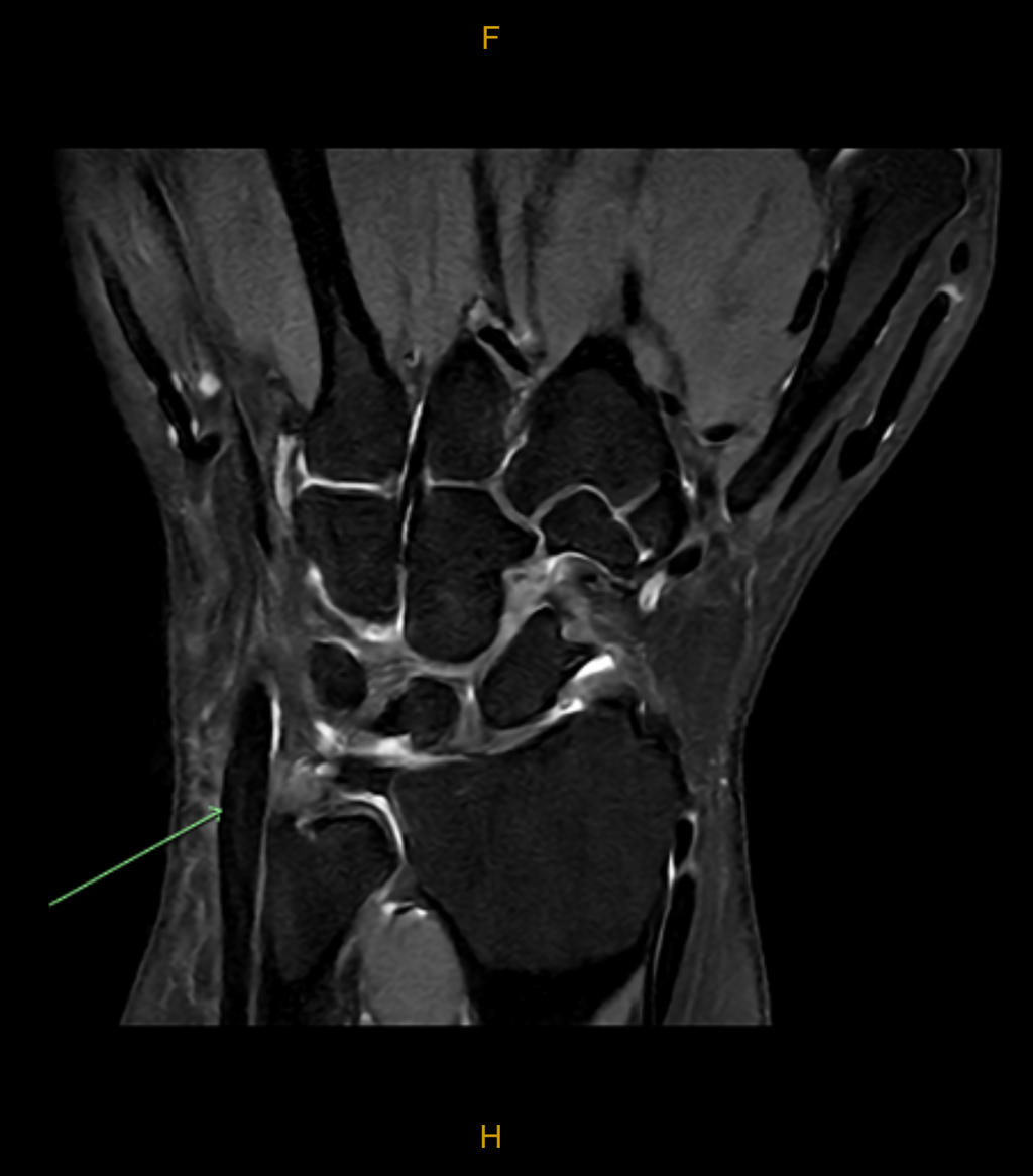 Acute Wrist Injury — Ultra-High-Resolution 3T MRI | Gold Coast