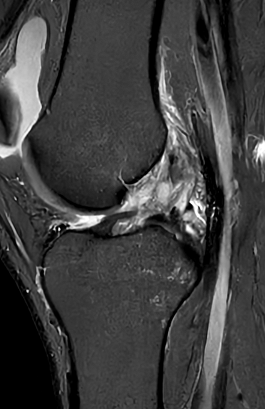 Acute Knee Injury — Ultra-High-Resolution 3T MRI | Gold Coast